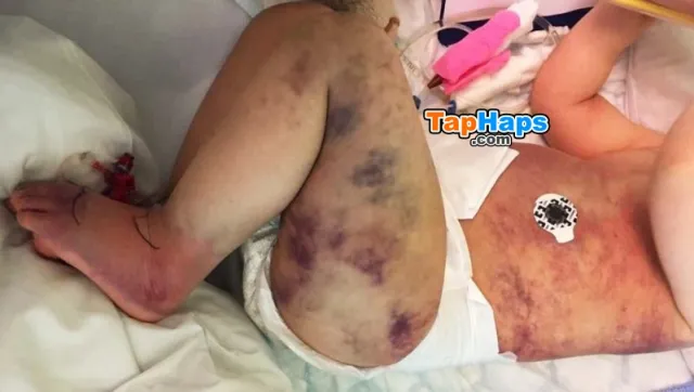 Elisabeth Nordgarden Mom Wrongly Believes Her Son Got Stung By Wasp His Body Turns Blue